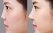 Nâng mũi cấu trúc 4D tái cấu trúc toàn diện cấu trúc mũi (Nguồn: Internet)